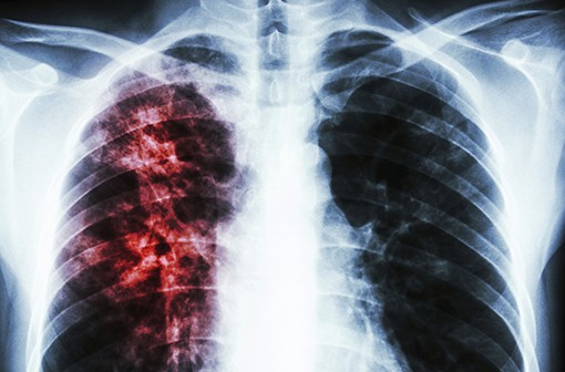 Tuberculose : le Congo dans le top 30 des pays les plus touchés au monde