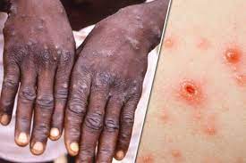 Maroc: Un premier cas détecté de la variole du singe