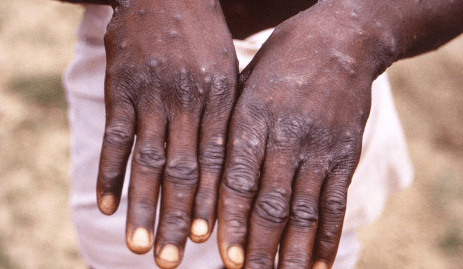 L’Afrique du Sud enregistre son premier cas de variole du singe