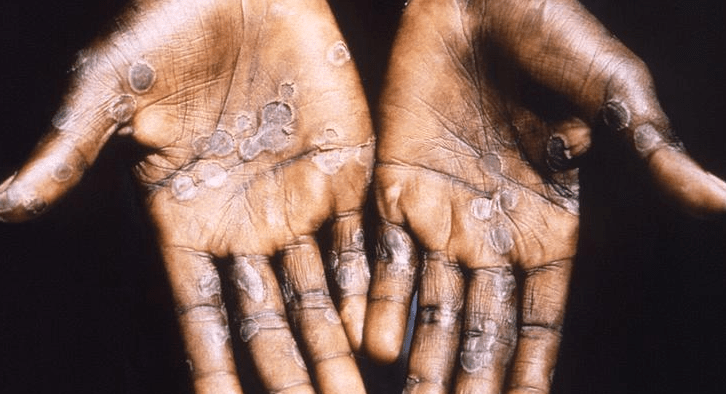 Afrique du Sud : quatrième cas de variole du singe