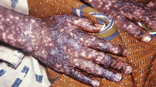 Congo-épidémie de monkey-pox : 59 cas enregistrés depuis le début de l’année