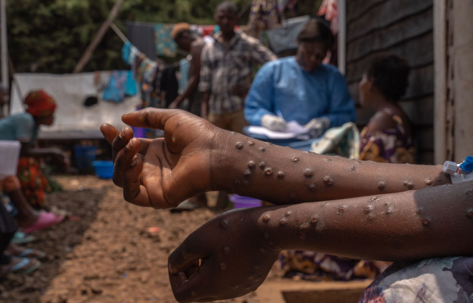 Congo : le plaidoyer du gouvernement pour une lutte efficacement contre le Mpox